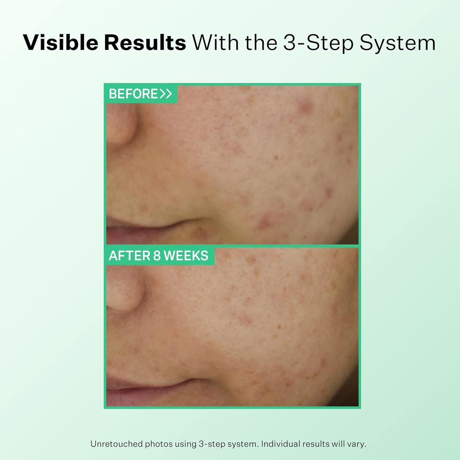 image:imageStriVectin Multi Action Clear for Acne and Blemish Prone Skin for Clearer Smooth and Brighter Skin Less Breakouts and Pimples for Healthy Looking SkinMulti Action Clear Acne Clearing Treatment Lotion 17 oz