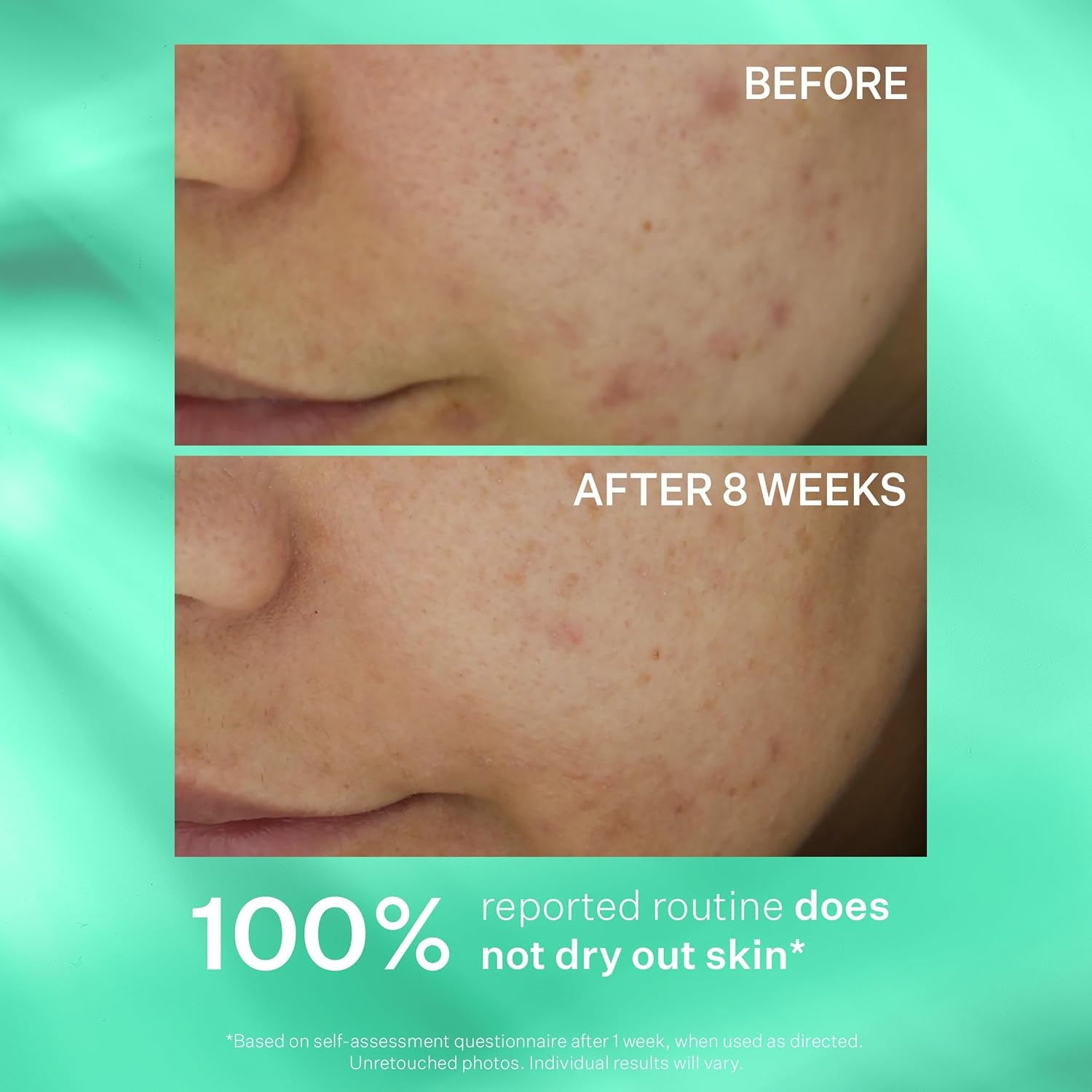image:imageStriVectin Multi Action Clear for Acne and Blemish Prone Skin for Clearer Smooth and Brighter Skin Less Breakouts and Pimples for Healthy Looking SkinMulti Action Clear Acne 30 day 3 Piece Trial Kit