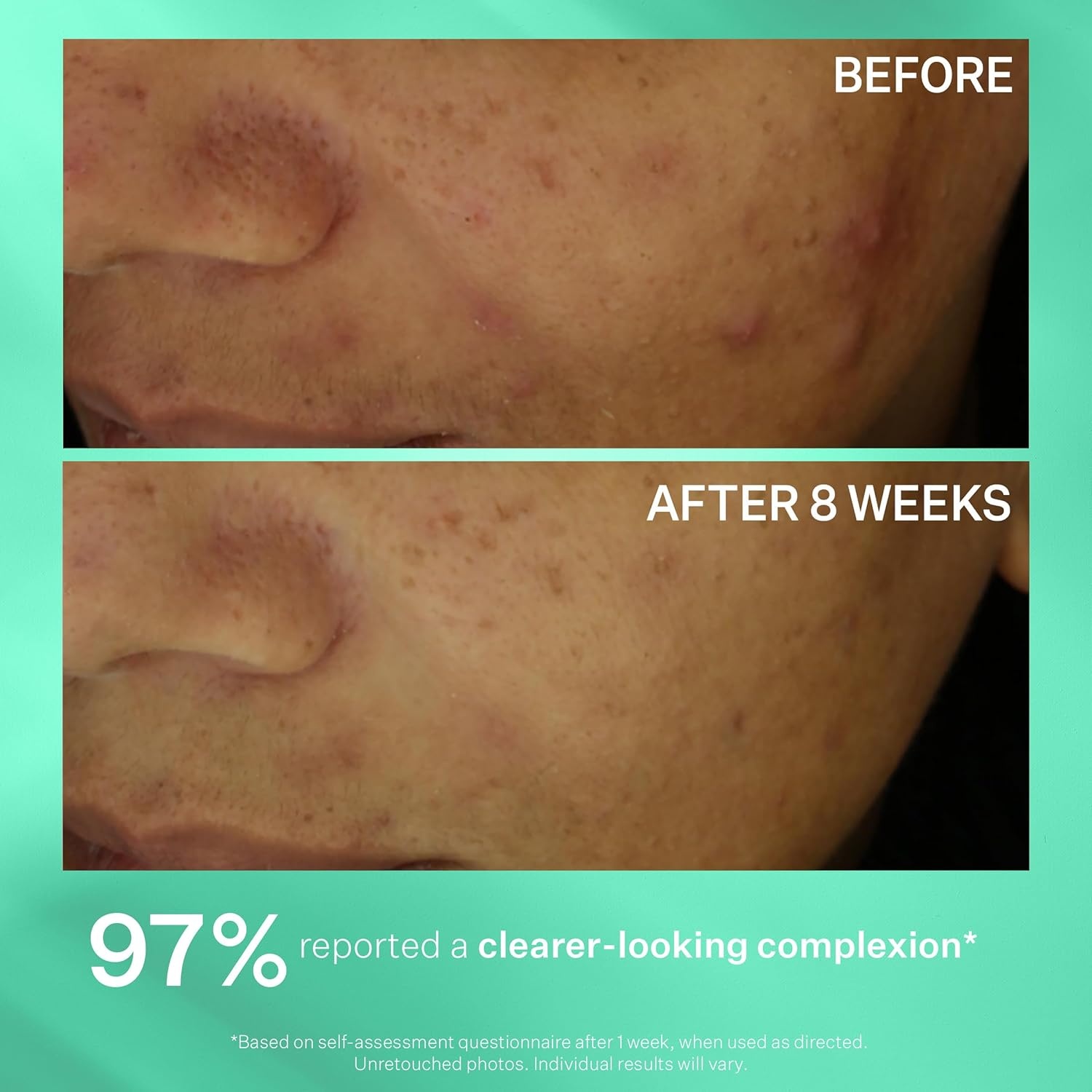 image:imageStriVectin Multi Action Clear for Acne and Blemish Prone Skin for Clearer Smooth and Brighter Skin Less Breakouts and Pimples for Healthy Looking SkinMulti Action Clear Acne 30 day 3 Piece Trial Kit